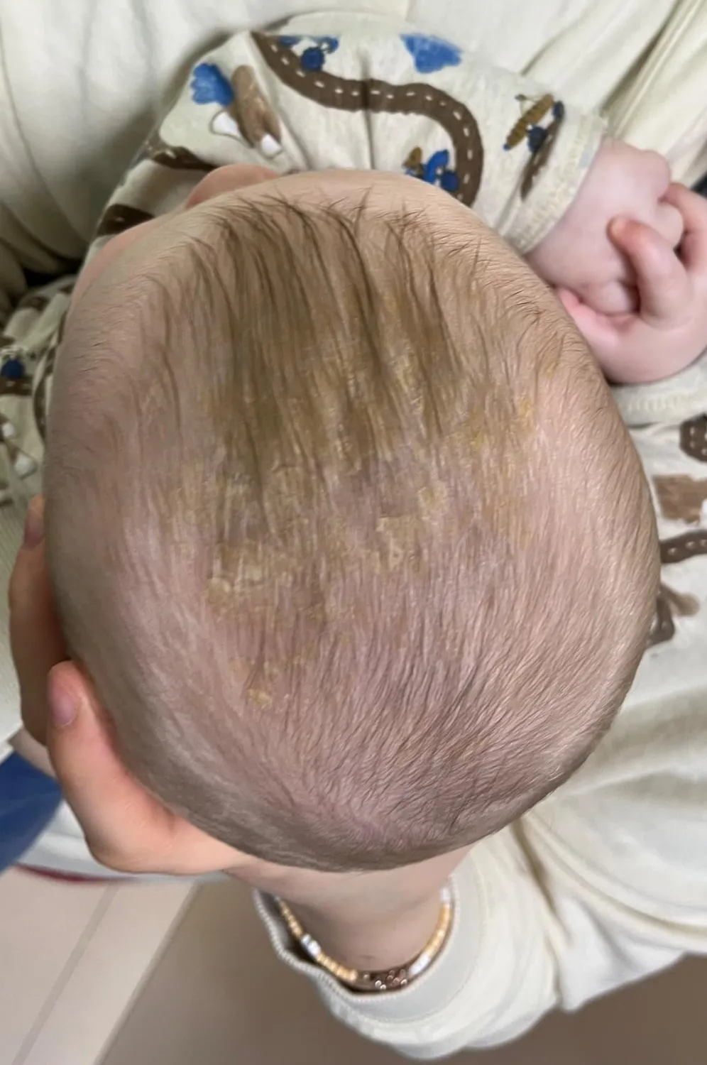 Frida Baby DermaFrida FlakeFixer Milchschorf 3-teilig